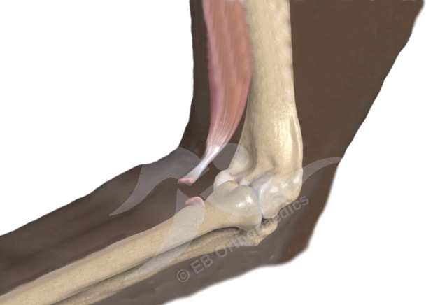 Distal biceps tendon rupture
